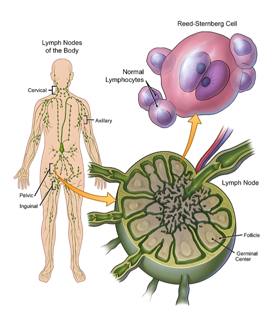 Wilm's tumor