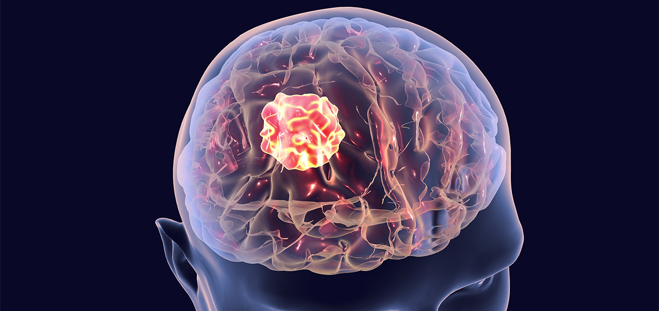 Low-Grade Glioma Treatment