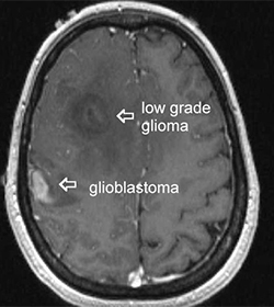 Understanding Low-Grade Glioma