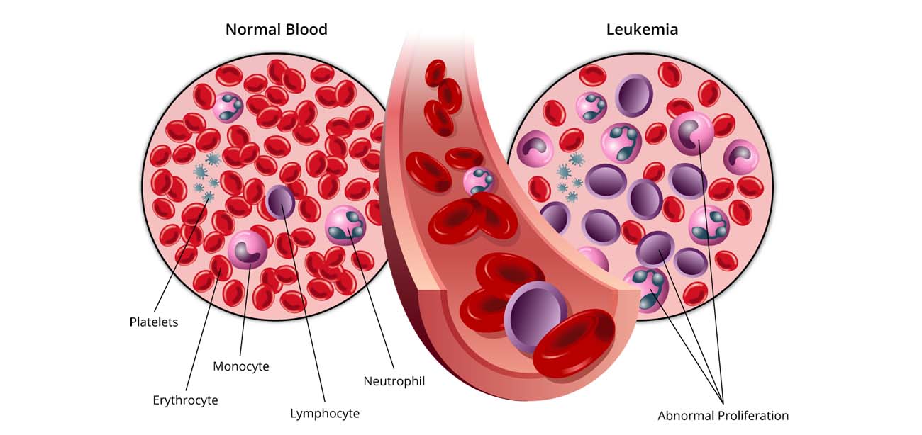 Acute Leukemia