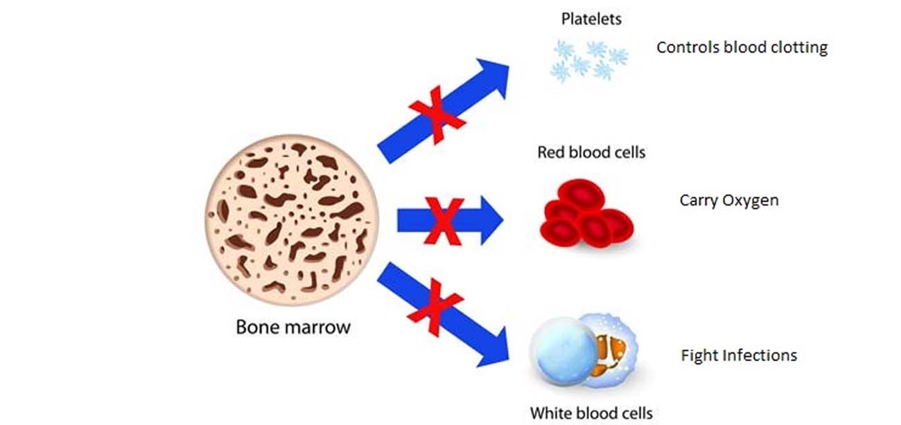 Aplastic Anemia