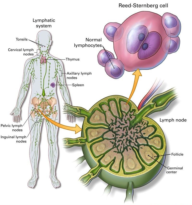 Hodgkin-Lymphoma