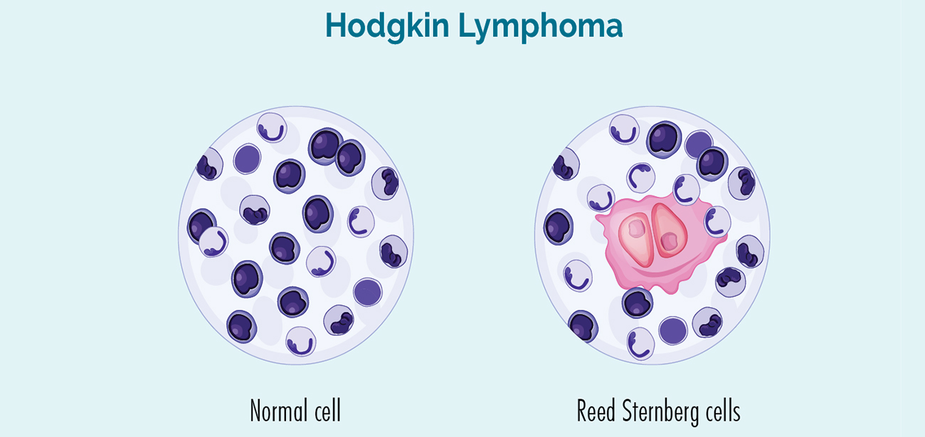 Hodgkin Lymphoma Treatment