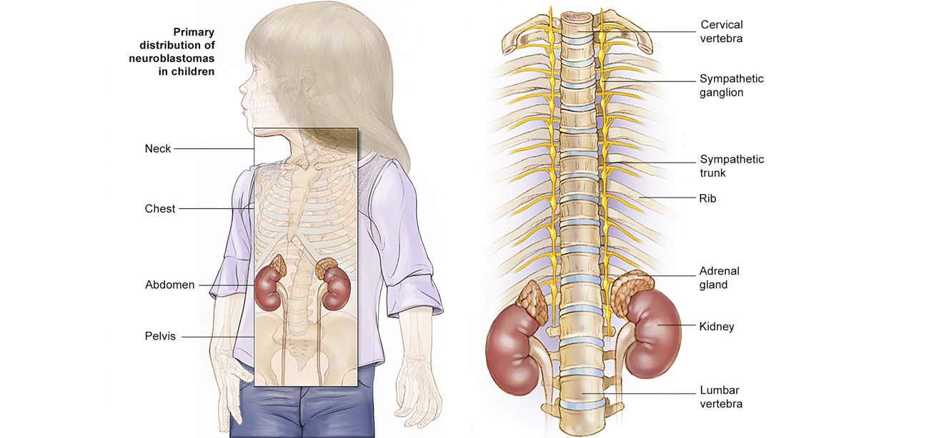 Neuroblastoma