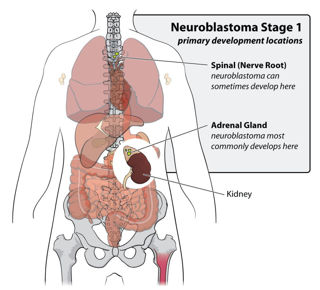 Wilms tumors