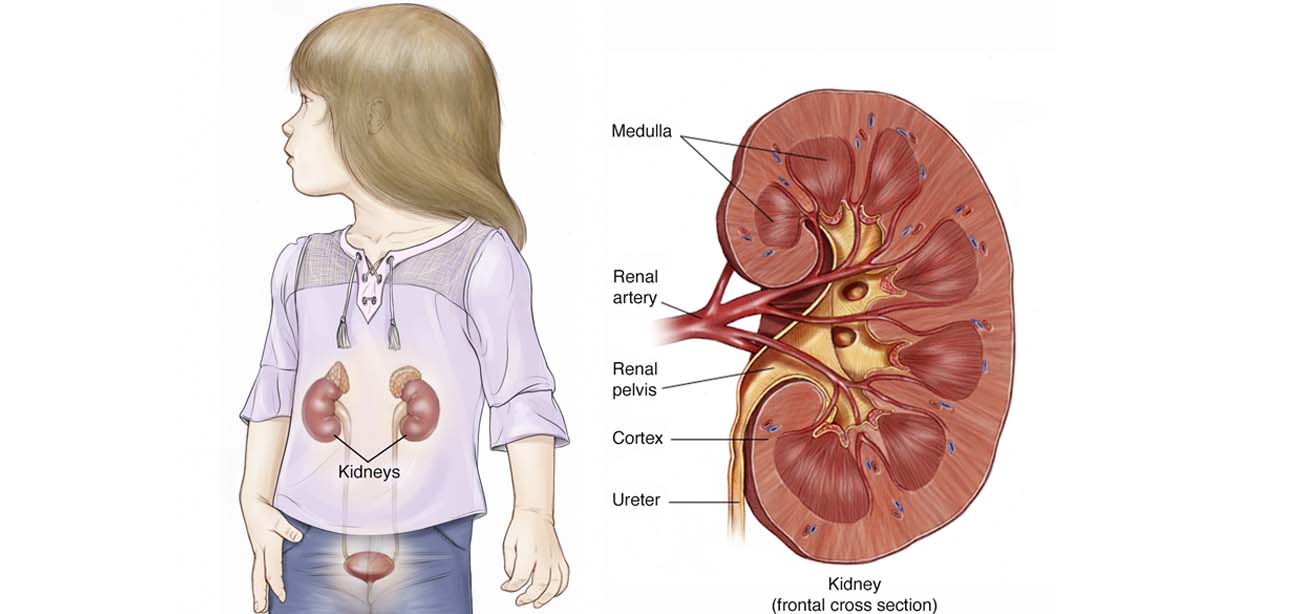 Wilm's tumor