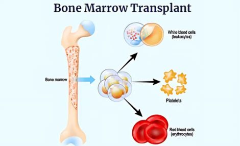 Bone Marrow Transplantation by Pediatric Hematologist in India, Dr. Shweta Bansal